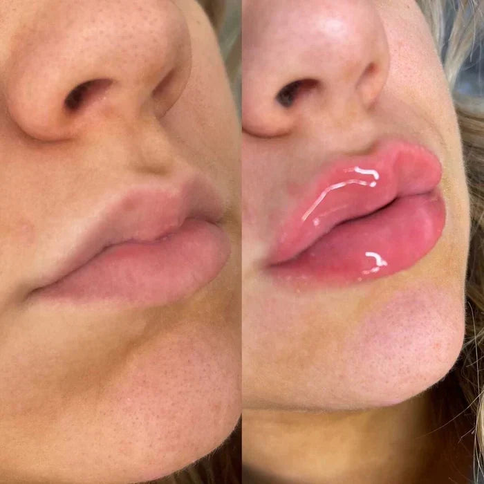 Sérum voluminizador de labios LumaGlow para labios más carnosos en minutos