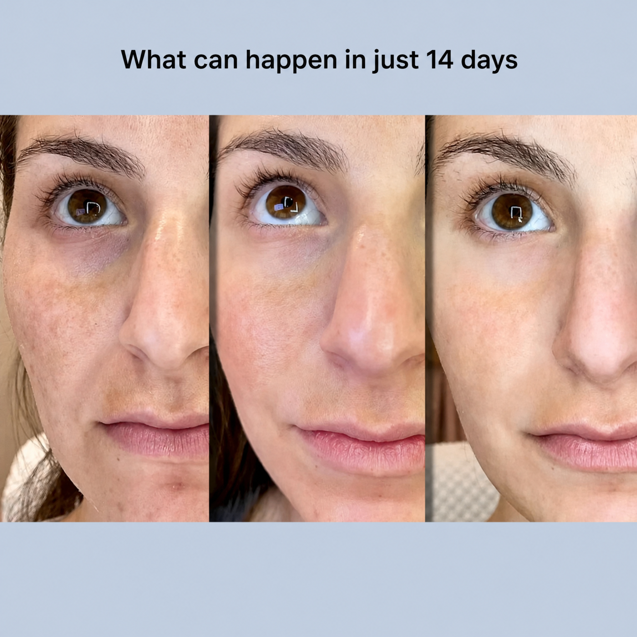 Tiras faciales efecto lifting | Alisa y reafirma al instante | Cuidado antiarrugas sin cirugía | YouthLift Renew